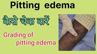 Pitting edema How to examine pitting edema Grades in pitting edema [upl. by Merill66]