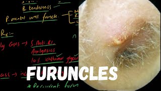 FURUNCLE  Localized Acute Otitis Externa [upl. by Anerres605]