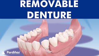 Removable partial denture © [upl. by Finny]