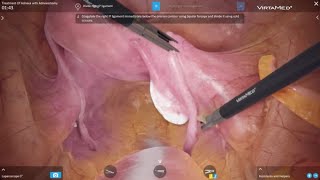 VirtaMed LaparoS™  Treatment of Adnexa with Adnexectomy [upl. by Zetnom]