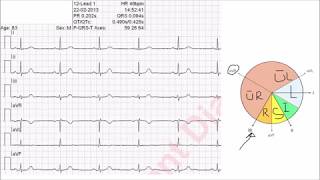 Bestimmung des Lagetyps vereinfachte Methode mit Tabelle oder Cabrera Kreis [upl. by Susie]