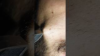 ingrown hair removal removery hairstyle hair [upl. by Lienahs370]