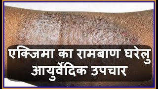 Health Tips एक्जिमा का रामबाण घरेलु आयुर्वेदिक उपचार  Charm Rog  Eczema ka Gharelu Upchar [upl. by Lecia]