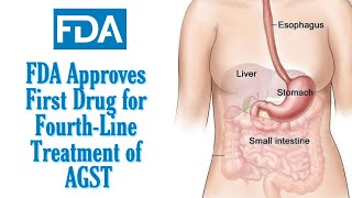 FDA Approves Qinlock ripretinib for FourthLine Treatment of AGST [upl. by Laerdna]