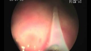 Video Tour Sigmoidoscopy and Polypectomy  wwwrkgastrolivercarecom [upl. by Decker]