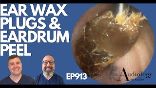 EAR WAX PLUGS amp EARDRUM PEEL  EP913 [upl. by Ahtimat]