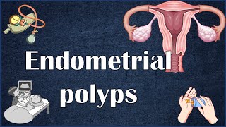 Endometrial Uterine Polyps  Everything You Need To Know [upl. by Dazraf]