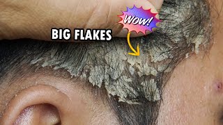 Big and Dry Dandruff Flakes Removal Dandruff Scratching Satisfying 356 [upl. by Iadrahs]