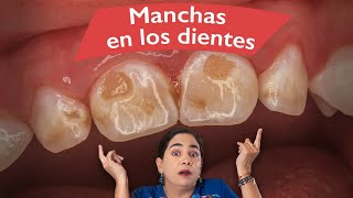 Manchas en los dientes ¿Qué son ¿Cómo tratarlas [upl. by Unders]