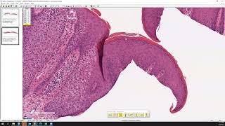 Clear cell acanthoma [upl. by Ardnuas724]