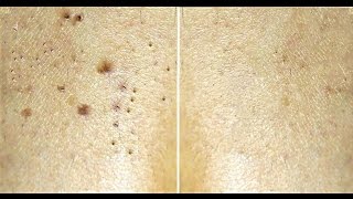 Dark Spot Removal  Home Remedy For Black Spots on Face  SuperWowStyle Skin Care [upl. by Steinberg742]