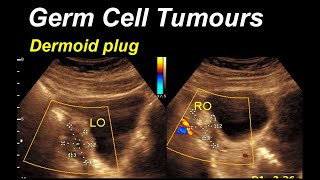 Adnexal cyst  Dermoid cyst Ovary [upl. by Suolkcin978]