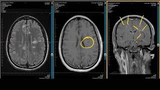 ADC Positive Multiple Sclerosis  Demyelination MRI Case Review [upl. by Nylsor]