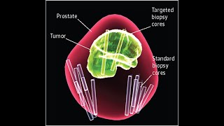 Explorando e entendendo os Tipos de Biópsia de Próstata [upl. by Frantz709]