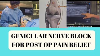 Ultrasound guided genicular nerve block for knee osteoarthritis in Chennai [upl. by Aiset323]