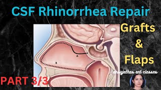 236Endoscopic Repair CSF Rhinorrhea Grafts and Flaps Part 33 surgeryeducation dentallectures [upl. by Ynatsyd]