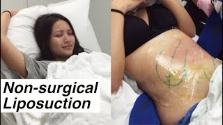 Liposuction Without Surgery  Coolsculpting  LaserAway [upl. by Peisch]