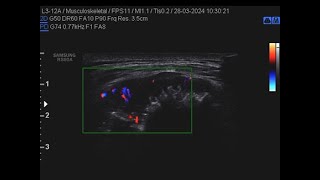 sarcoma della parete toracica [upl. by Ianaj]