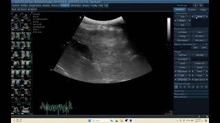 IQ 155 LIVER HEPATOMA ULTRASOUND ECHOPAC ECHOCARDIOGRAPHY HEPATOMA C1 5 RS PROBE [upl. by Dow]