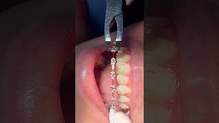 This Is Why Getting Braces Removed Is PAINLESS 😃🦷 [upl. by Ahsinned]