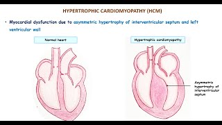 Hypertrophic cardiomyopathy [upl. by Jobi]