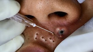 Big Cystic Acne Blackheads Extraction Blackheads amp Milia Whiteheads Removal Pimple Popping [upl. by Petes961]