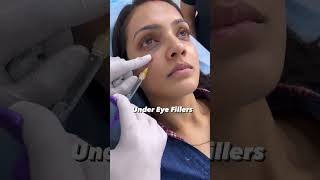 under eye filler treatment helps you get rid of wrinkles  Dermalyn Aesthetics  Dr Muskan Tyagi [upl. by Hamrnand938]