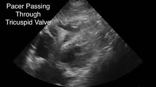 Emergency Transvenous Pacemaker Placement Guided w POCUS [upl. by Jurgen723]