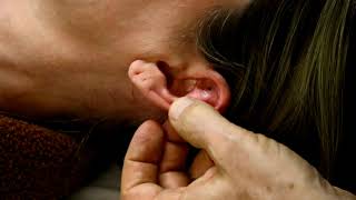 Ear Seed Demonstration with Dr Bob Quinn [upl. by Moishe974]