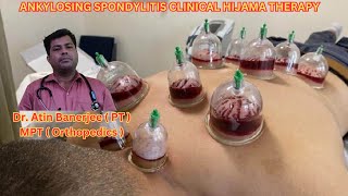 ANKYLOSING SPONDYLITIS CLINICAL HIJAMA THERAPY [upl. by Ahusoj]