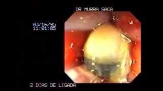 Video Hemorrhoids rubber band ligation 2 [upl. by Enirehtak]