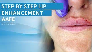 Lip Filler Tutorial  Post Care Procedure [upl. by Niwrehs]