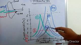 Tympanometry Impedance Audiometry [upl. by Florry]