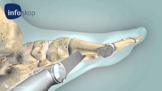 3D medical animation  Osteotomy  Hallux Valgus  designidentity [upl. by Francine283]