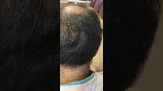 Donor Area after Hair Transplant Fue has More Scar than FUT [upl. by Sacrod]