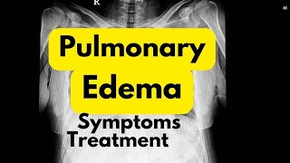 Pulmonary edema symptoms treatment in Hindi  lungs me Pani bharne se kya hota hai [upl. by Rad]