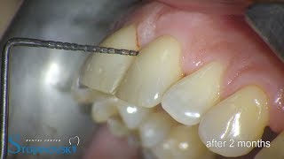 Periodontal treatment MTD  Gelcide diode laser [upl. by Lerred607]