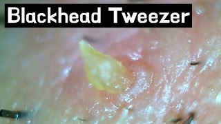 15 Pull out Blackheads  Whiteheads Close up 300X  Blackheads Removal [upl. by Nnaes229]