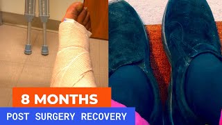 Haglund’s Deformity Surgery Recovery Update 8 months later [upl. by Nioe]