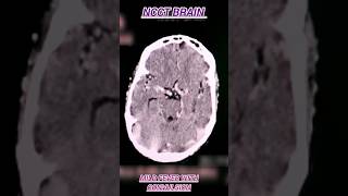 NCCT Brain l mild fever with convulsion shorts ctscan [upl. by Kcired]