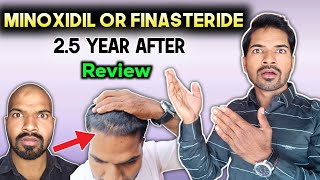 Minoxidil or Finasteride 25 year After review [upl. by Crissie]