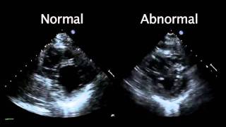 Echocardiogram from the Patient Compared with That from a Normal Control  NEJM [upl. by Anitnas84]