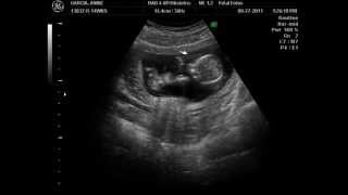 14 week ultrasound Its a Boy [upl. by Millie]