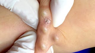 Pimple Popping Blackheads On Skin 😲😲 [upl. by Akirdnas]