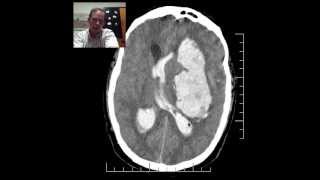 CT Head HTN Hemorrhage w Herniation DISCUSSION by Radiologist [upl. by Kobylak380]