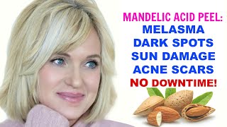 MANDELIC ACID PEEL MELASMA DARK SPOTS HYPERPIGMENTATION SUN DAMAGE amp ACNE Skincare Over 50 [upl. by Adnohr]