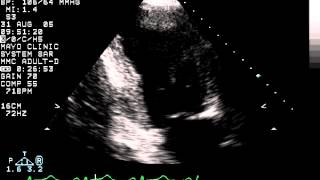 Left atrial appendage seen on transthoracic echocardiography [upl. by Adlai]