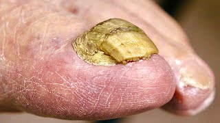 Super THICK BIG TOENAIL Trimming NAIL FUNGUS OR DAMAGED TOENAIL [upl. by Ratib]