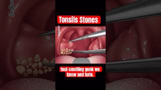 TONSILS STONES TONSILLITIS [upl. by Anwad]