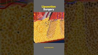 Liposuction Surgery [upl. by Augusto]